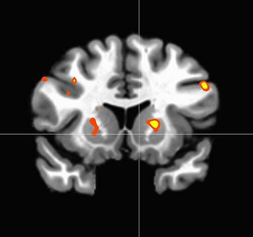 A brain scan of a monk actively extending compassion shows activity in the striatum, an area of the brain associated with reward processing. Photo: SPAN Lab, Stanford University / SF